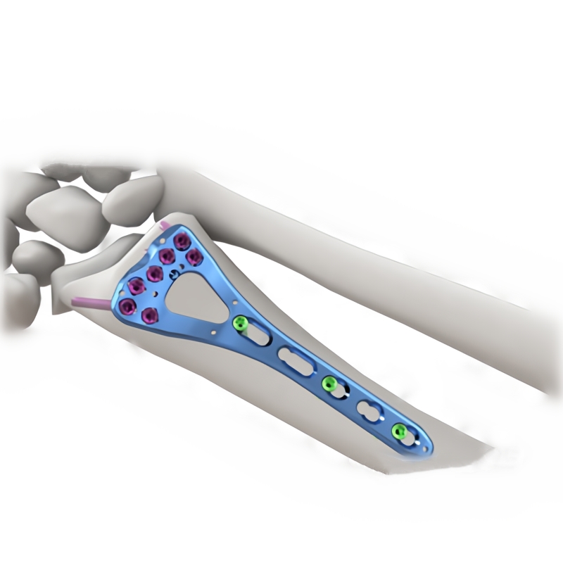 Distal Radius Medial Locking Plates Ι