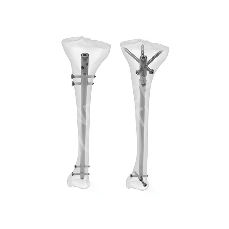 Tibia Intramedullary Nail System